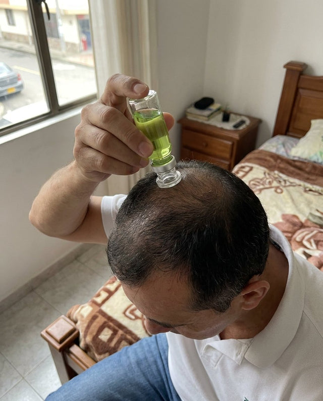Hombre en Bucaramanga aplicándose el kit en la coronilla